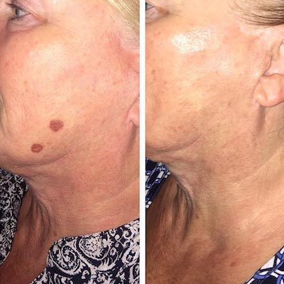 Age Spot Removal