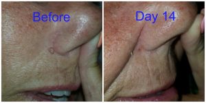 Skin Tag Nose